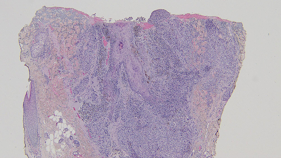 Distant-view-of-the-subsequent-punch-biopsy-to-evaluate-the-residual-pigment-observed-clinically-in-the-center-of-the-biopsy-site-after-the-shave-biopsy-was-performed.