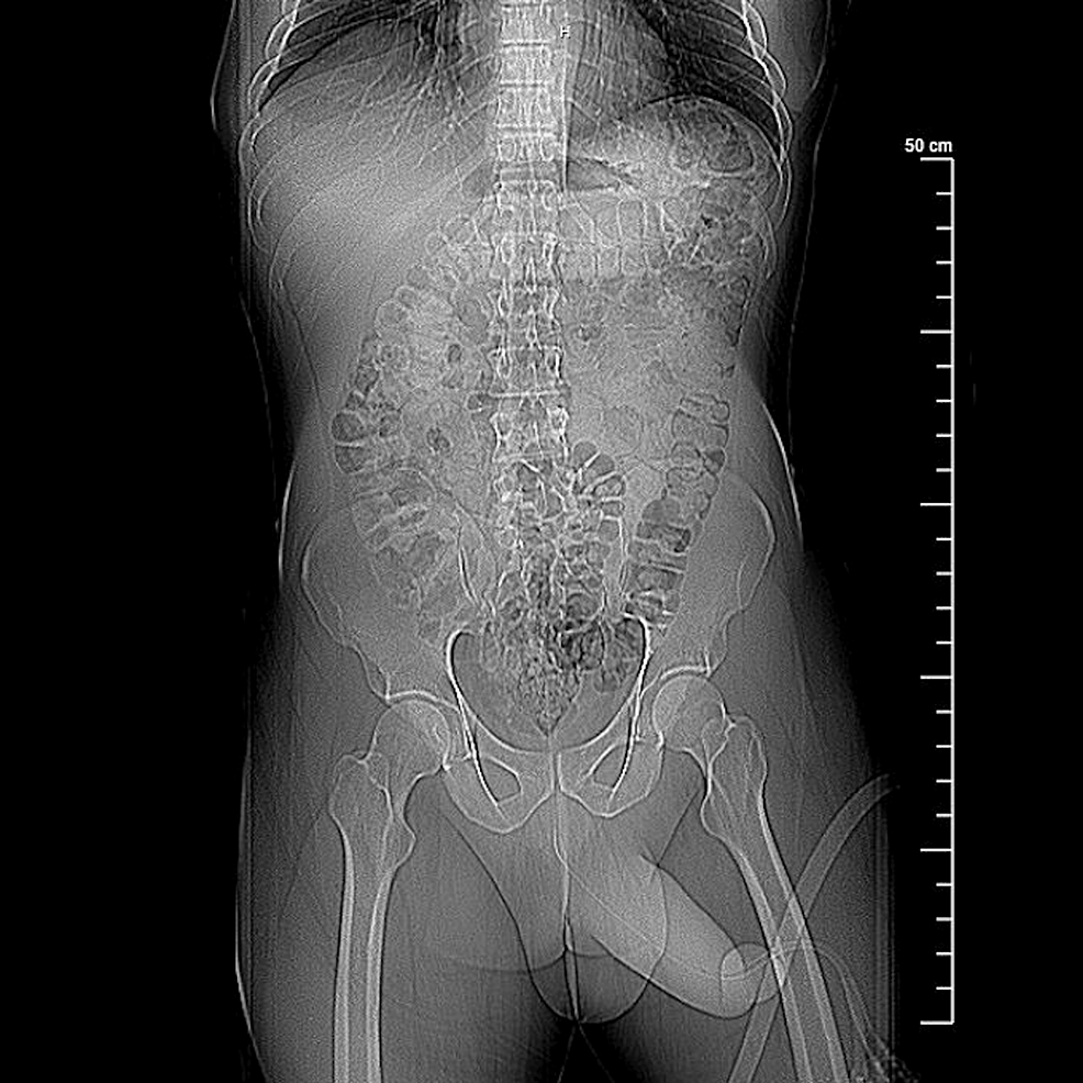 A Patient Diagnosed With Priapism: Key Clinical Manifestations