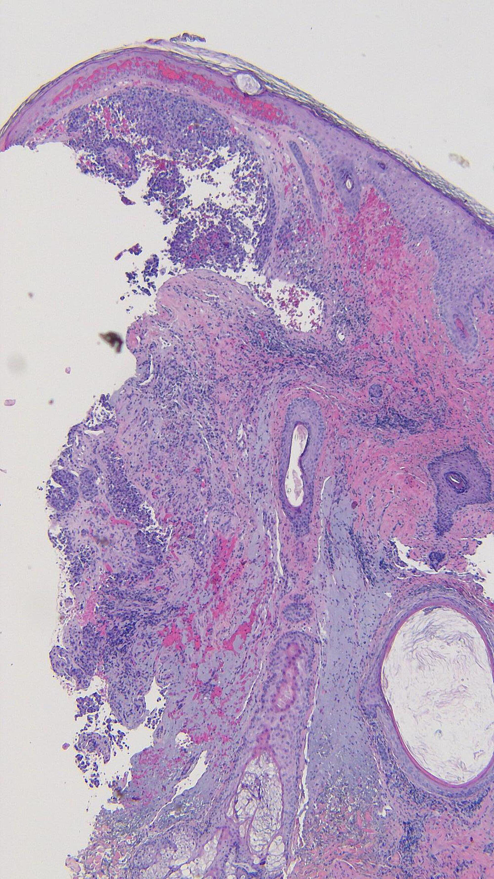 Cureus Tumoral Melanosis Associated with PembrolizumabTreated