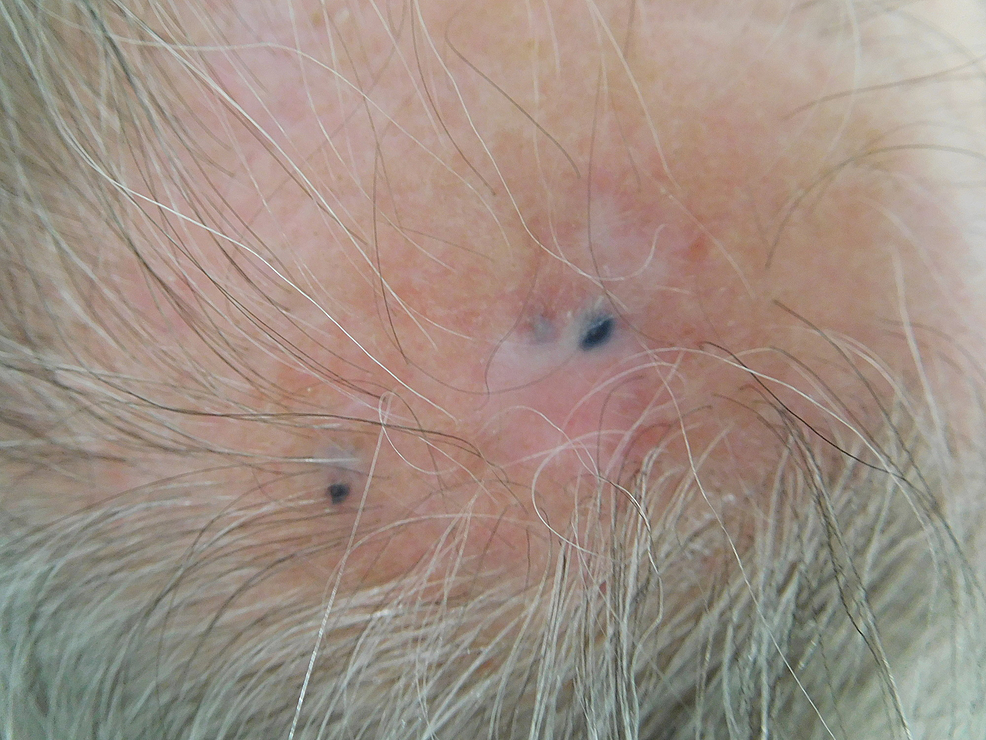 Tumoral-melanosis-on-the-left-parietal-scalp.