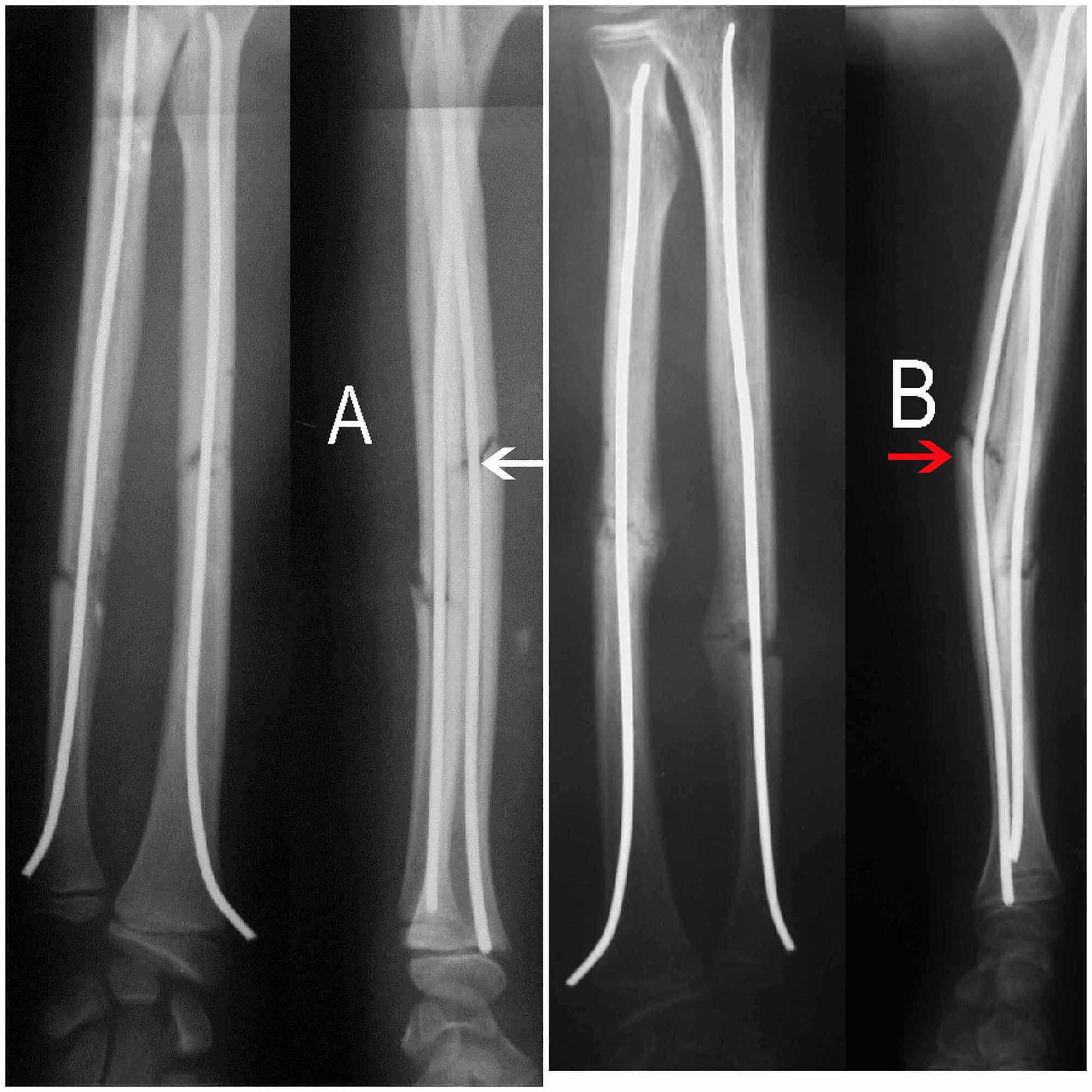 Pdf Retrograde Fixation Of The Ulna In Pediatric Forearm Fractures ...