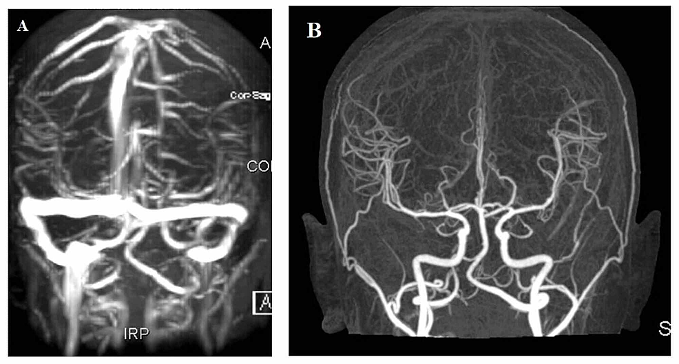 Cureus | Acute Subdural Haemorrhage as a Complication of Diagnostic ...