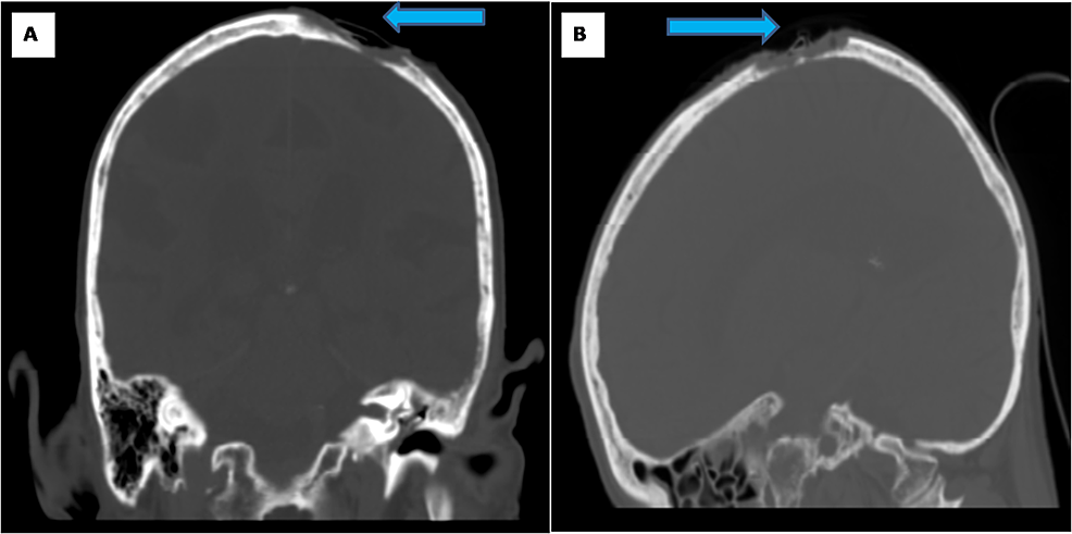 Malignant Fibrous Histiocytoma of the Scalp with Skull Invasion: A Rare ...