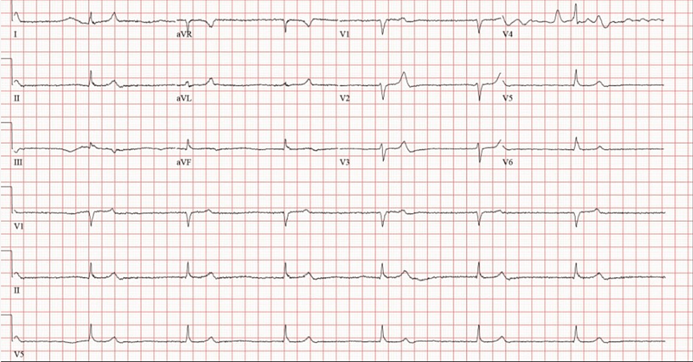 A Case of BRASH (Bradycardia, Renal Dysfunction, Atrioventricular Node ...