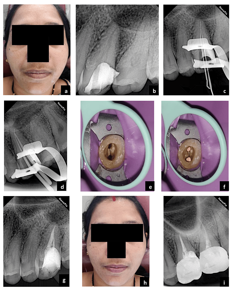 A Rare Case of Single-Rooted Maxillary First Molar With Type