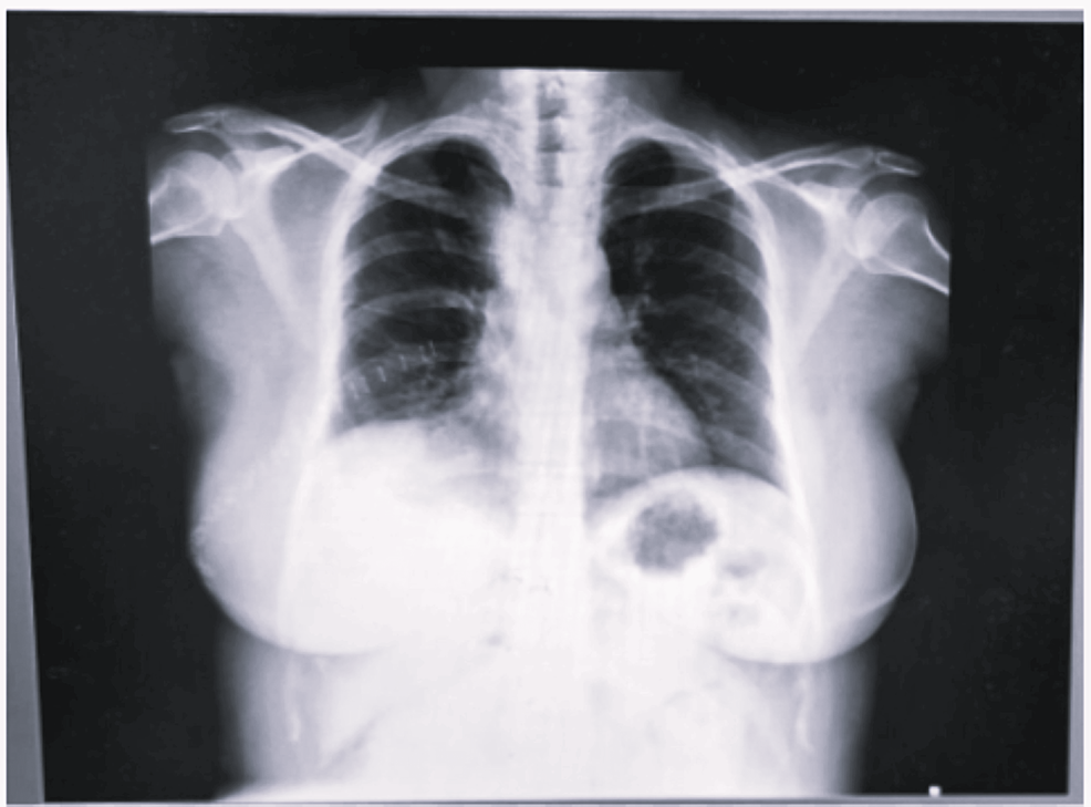 Postoperative-chest-X-ray-PA-view