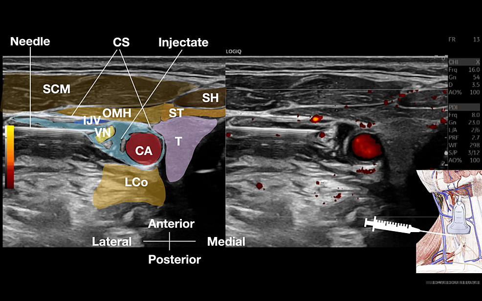 健康・医学 Electrophysiological Maneuvers Electrophysiological Maneuvers for Arrhythmia Analysis