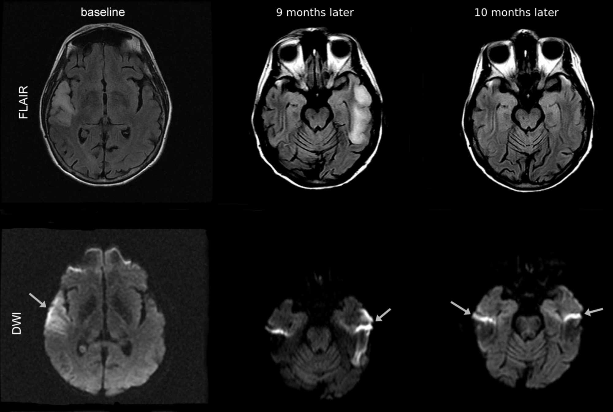 Cureus | Late-onset Mitochondrial Encephalomyopathy with Lactic ...