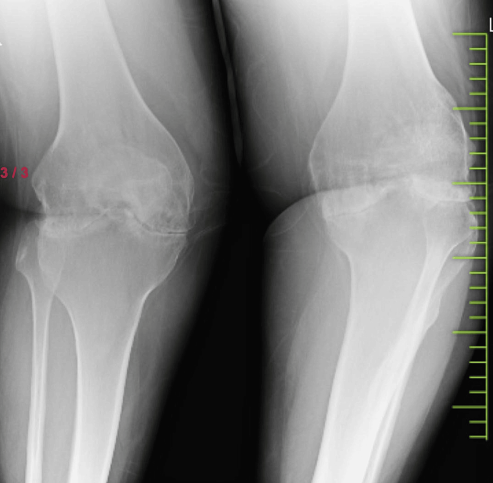 Successful Knee Replacement in a Patient With a History of Multiple Knee  Surgeries: A Case Report | Cureus