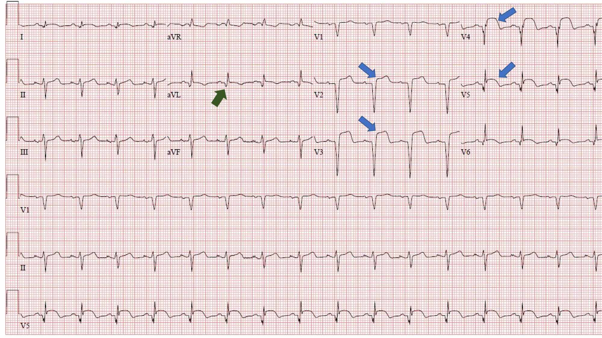 Anterior St Segment Elevation