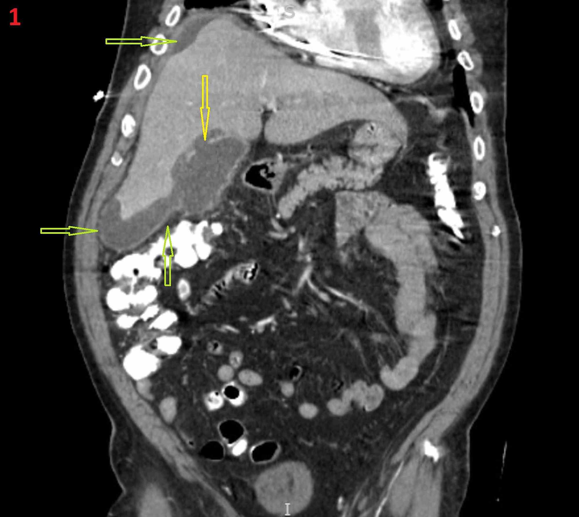 Cureus Perforated Gangrenous Gallbladder In An Asymptomatic Patient