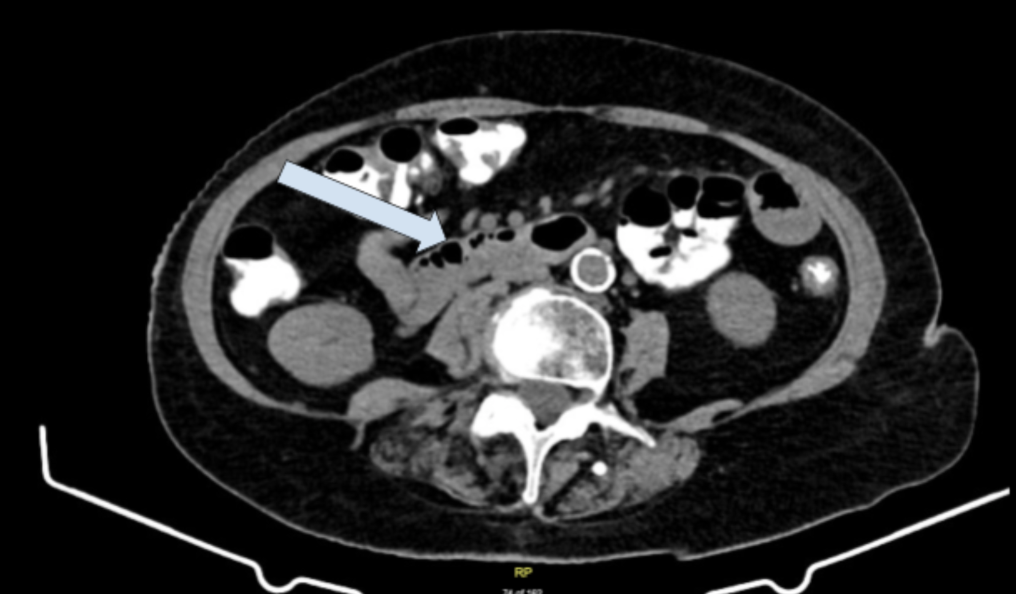 Cureus Focal Active Colitis Presented With Chronic Diarrhea