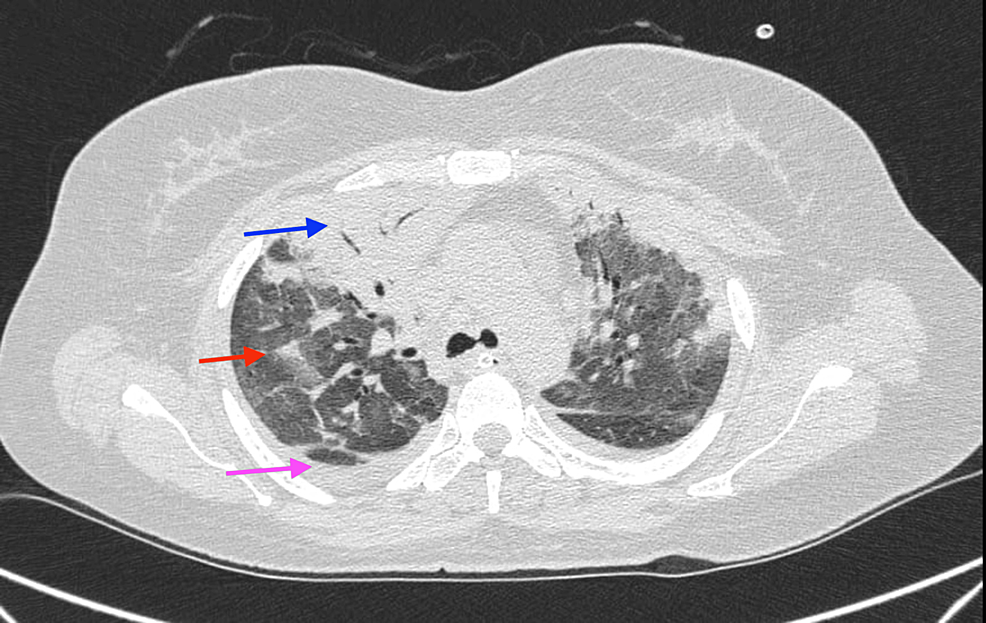 Computed-tomography-(CT)-scan-of-thorax-(coronal-view)-showing-right-upper-lobe-consolidation-(blue-arrow),-extensive-ground-glass-opacities-(red-arrow),-bilateral-moderate-pleural-effusion-(pink-arrow).