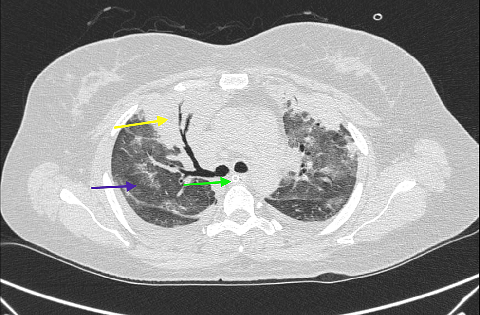 Computed-tomography-(CT)-scan-of-thorax-(coronal-view)-showing-right-upper-lobe-consolidation-with-air-bronchogram-(yellow-arrow),-extensive-ground-glass-opacities-with-fissural-effusion-(purple-arrow)-and-tracheostomy-tube-in-situ-(green-arrow).