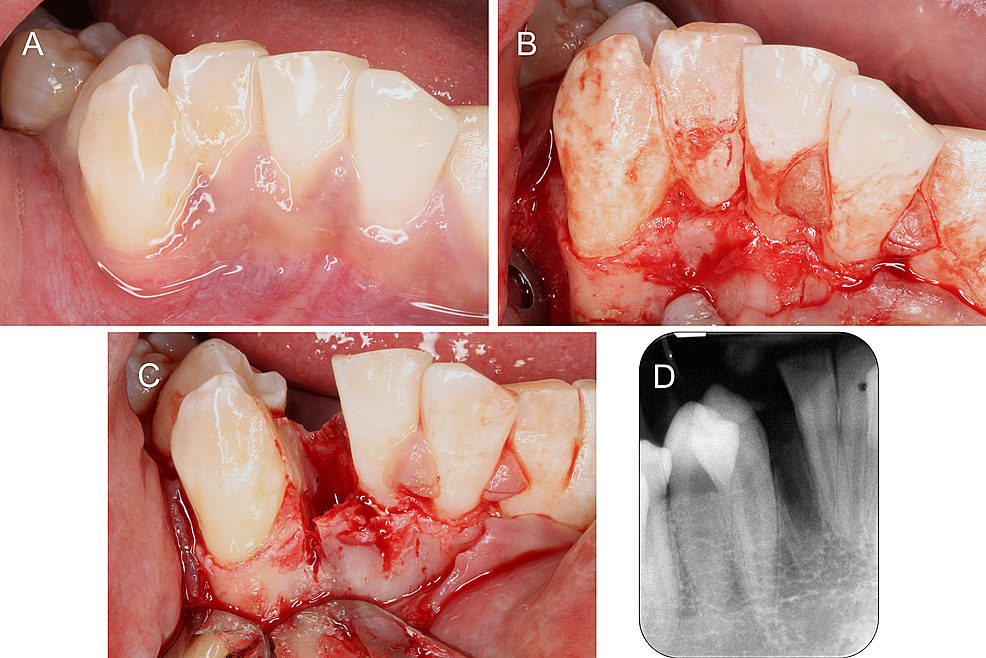 Cureus Management of Bilateral Mandibular Fused Teeth