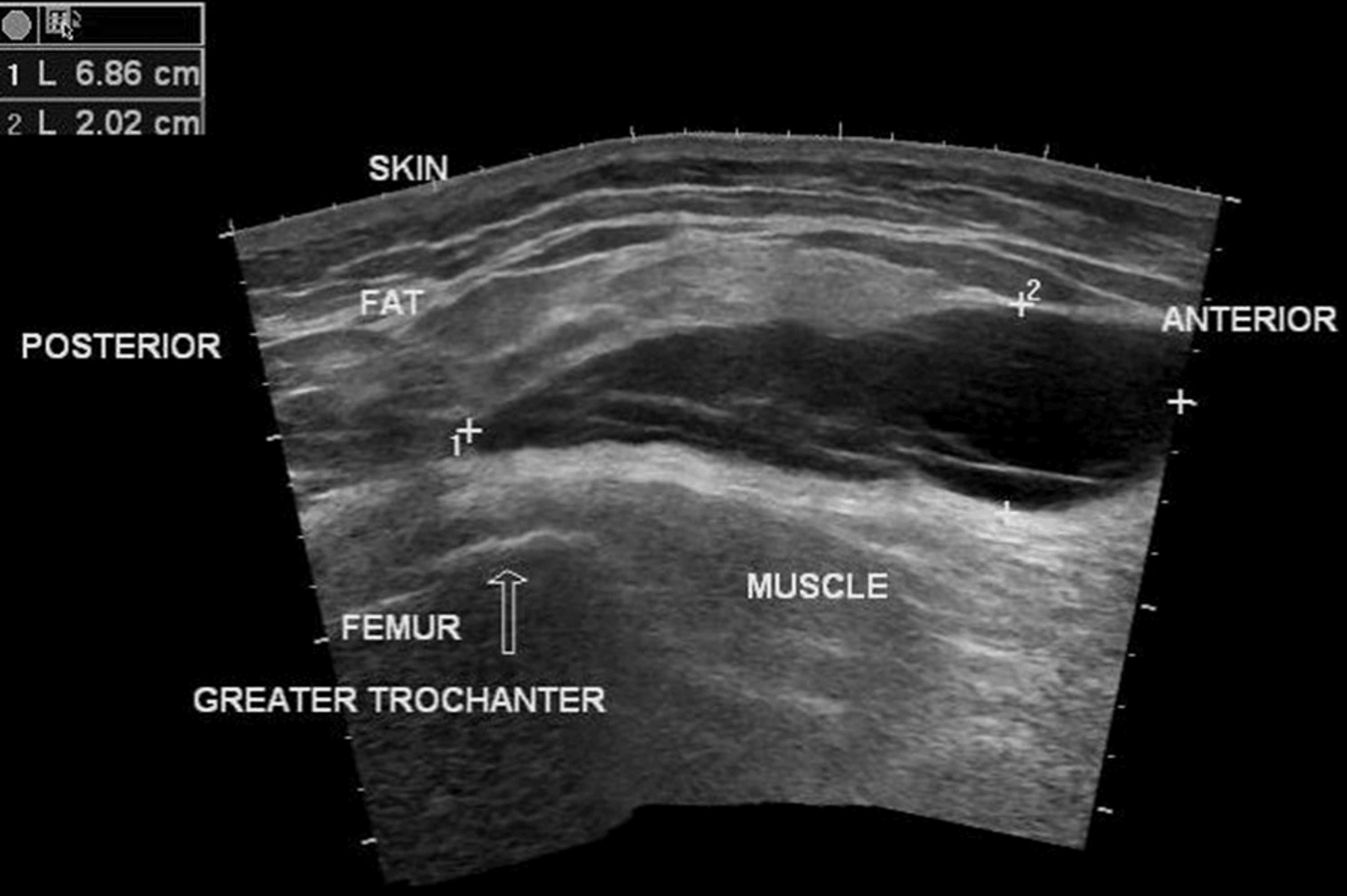 MorelLavallee Lesion Associated With Rhabdomyolysis in Polytrauma Cureus