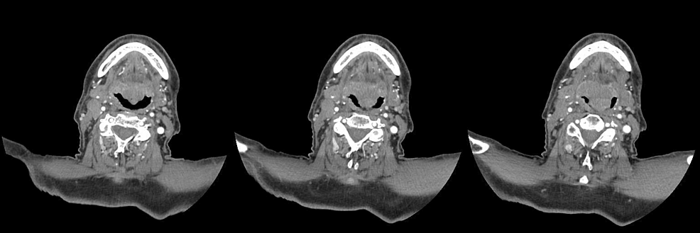 Case-1-CT-scan-of-the-neck-showed-swelling-in-the-right-median-paramedian-site-with-homogeneous-density,-involving-the-lingual-surface-of-the-epiglottis-and-the-root-of-the-tongue.-The-glottic-plane-is-asymmetrical,-with-thickening-of-the-posterior-and-left-lateral-walls-of-the-larynx-in-the-supraglottic-position Case-1-CT-scan-of-the-neck-showed-swelling-in-the-right-median-paramedian-site-with-homogeneous-density,-involving-the-lingual-surface-of-the-epiglottis-and-the-root-of-the-tongue.-The-glottic-plane-is-asymmetrical,-with-thickening-of-the-posterior-and-left-lateral-walls-of-the-larynx-in-the-supraglottic-position