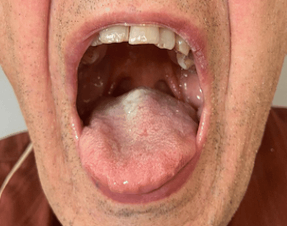 Case-1-evaluation-of-the-Mallampati-score:-visualization-of-only-the-base-of-the-uvula-(grade-3) Case-1-evaluation-of-the-Mallampati-score:-visualization-of-only-the-base-of-the-uvula-(grade-3)
