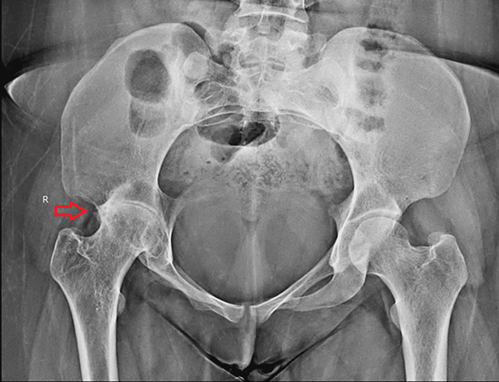 Management of Tuberculosis of the Hip With Antitubercular