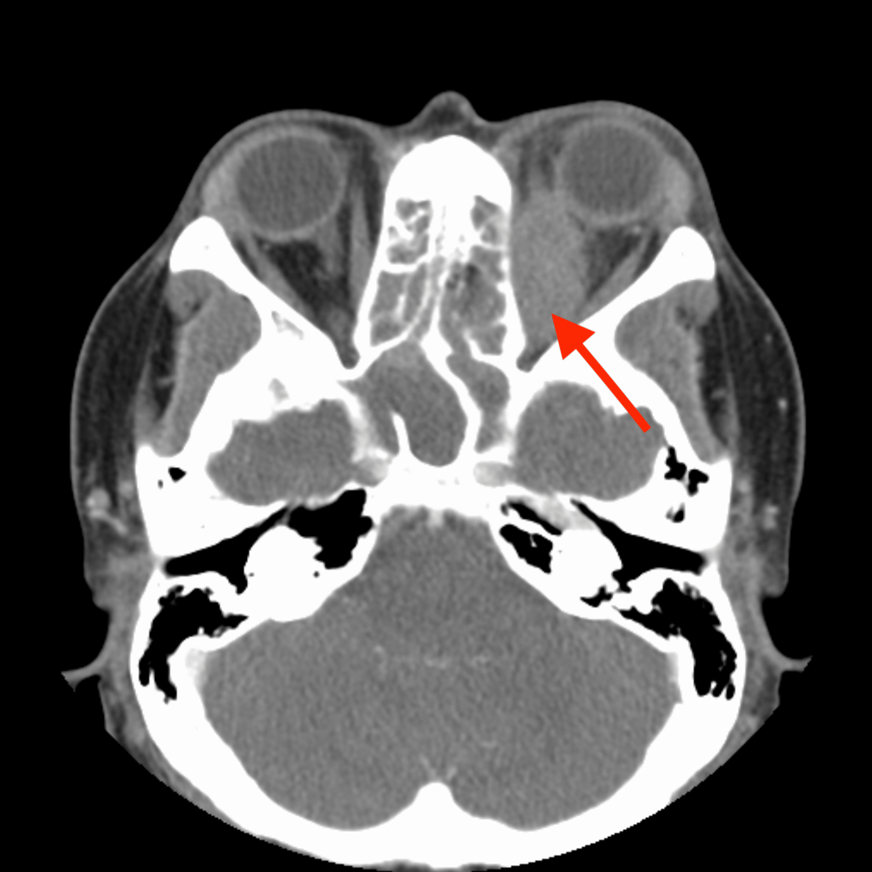 Cureus Granulomatosis With Polyangiitis Presenting As Orbital Apex