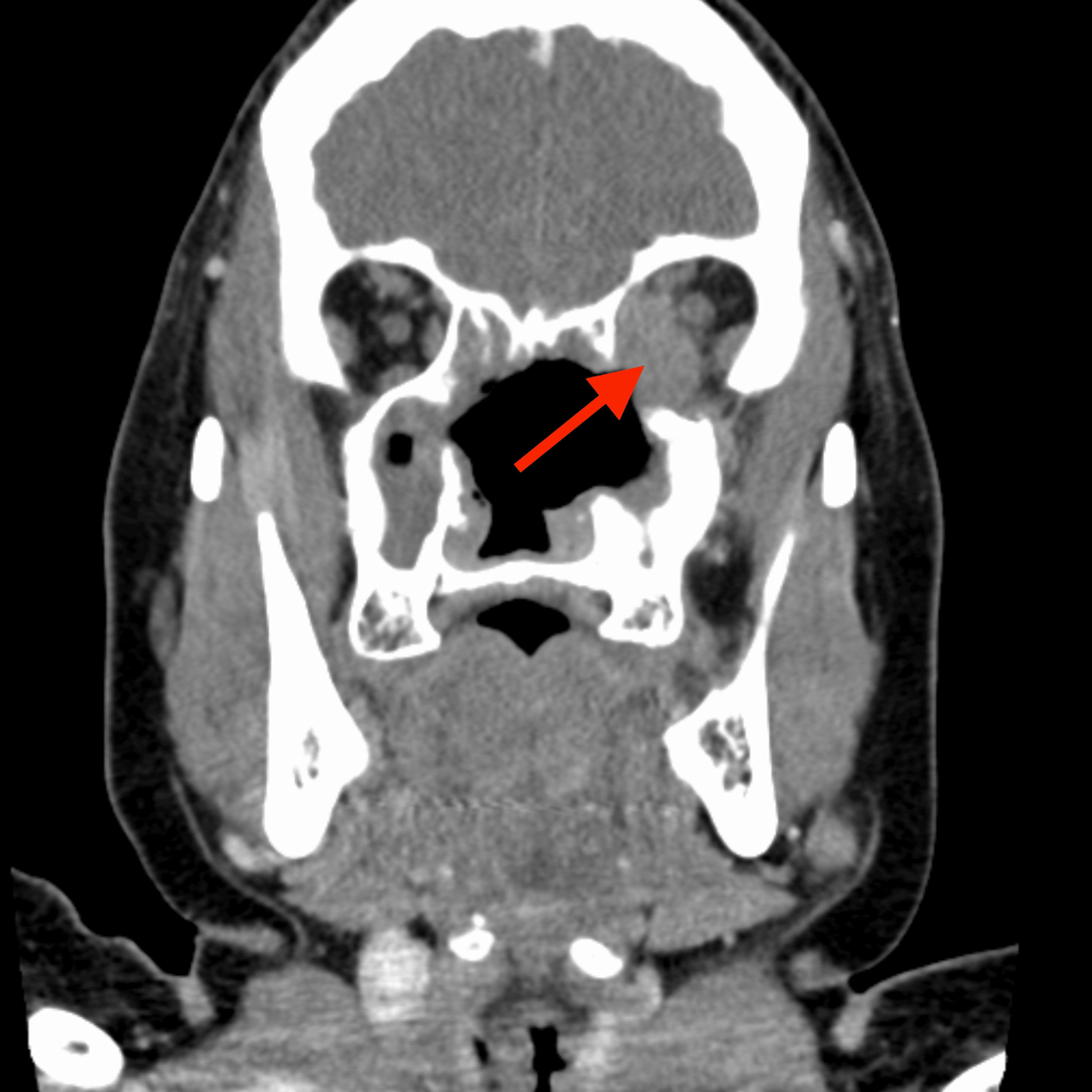 Cureus Granulomatosis With Polyangiitis Presenting As Orbital Apex