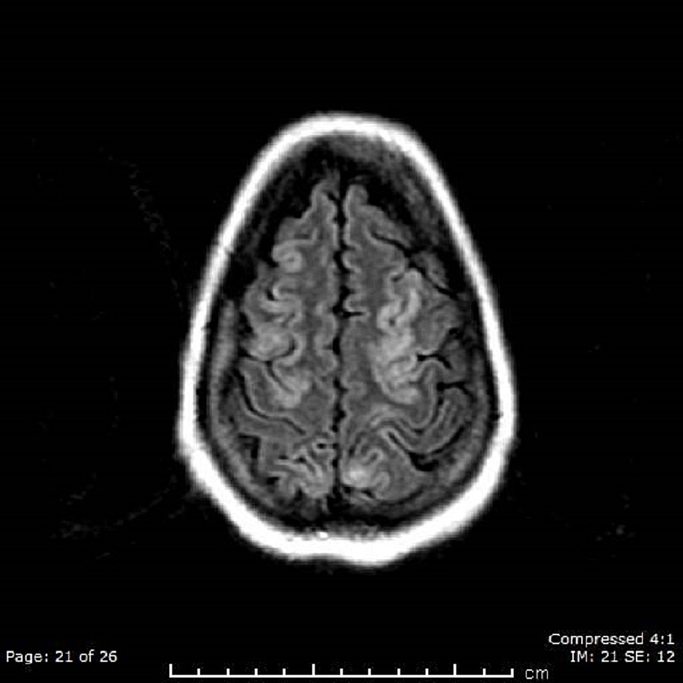 Brain-MRI-Shows-Abnormal-Signal-at-the-Parieto-occipital-Region-