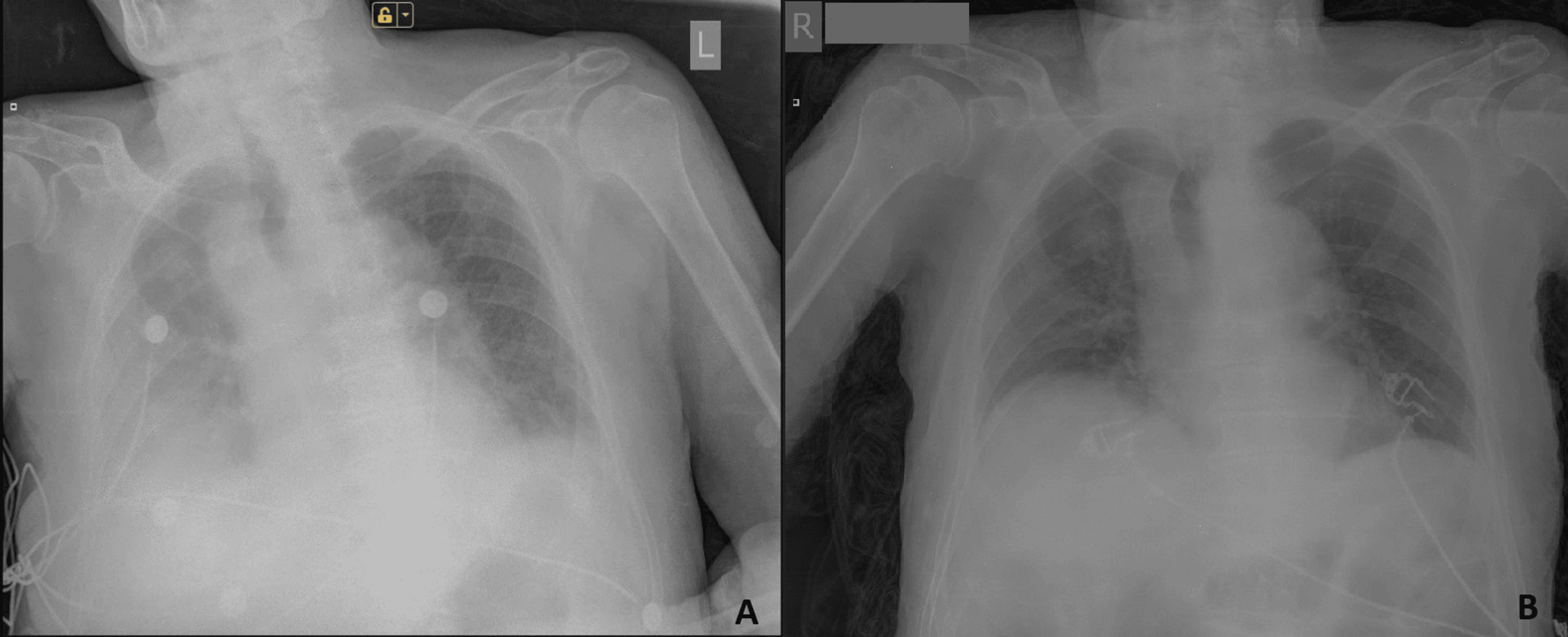 successful-treatment-with-high-dose-colchicine-of-a-101-year-old