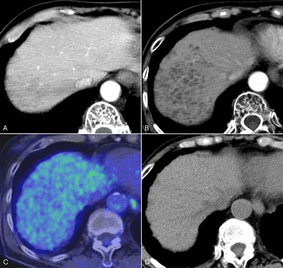 Longitudinal CT, MRI, And 18F-FDG PET/CT Imaging Findings Of Peliosis ...