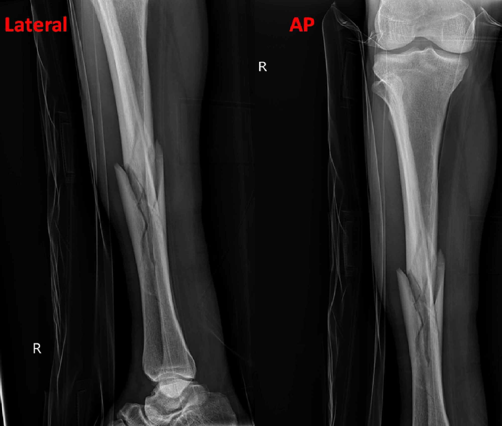 tibia fracture