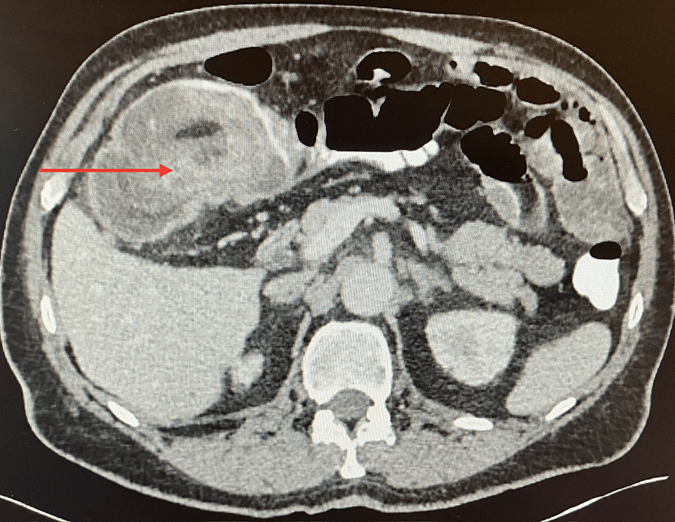 大腸がんによる回腸結腸重積症：成人の腹痛のまれな原因
