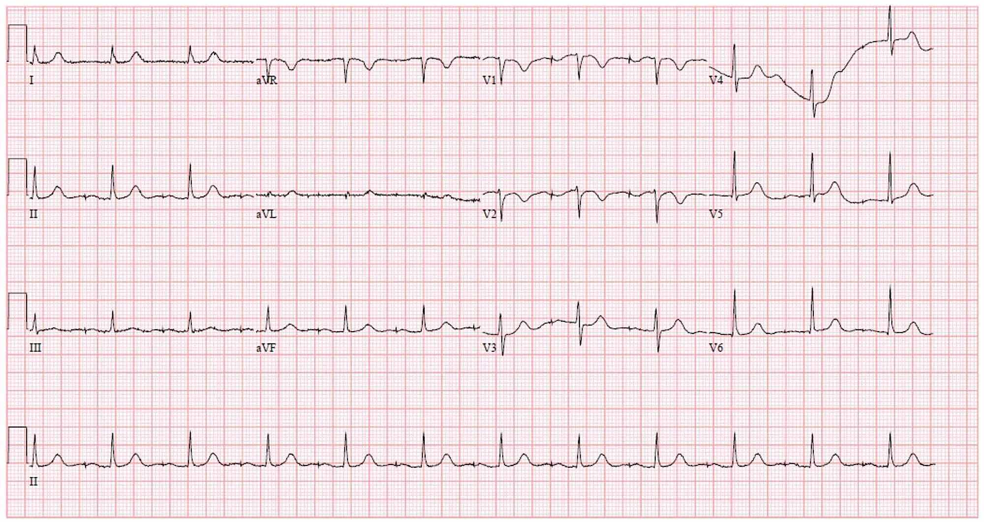 Cureus | A Case of Amiodarone Pulmonary Toxicity with Short-term ...