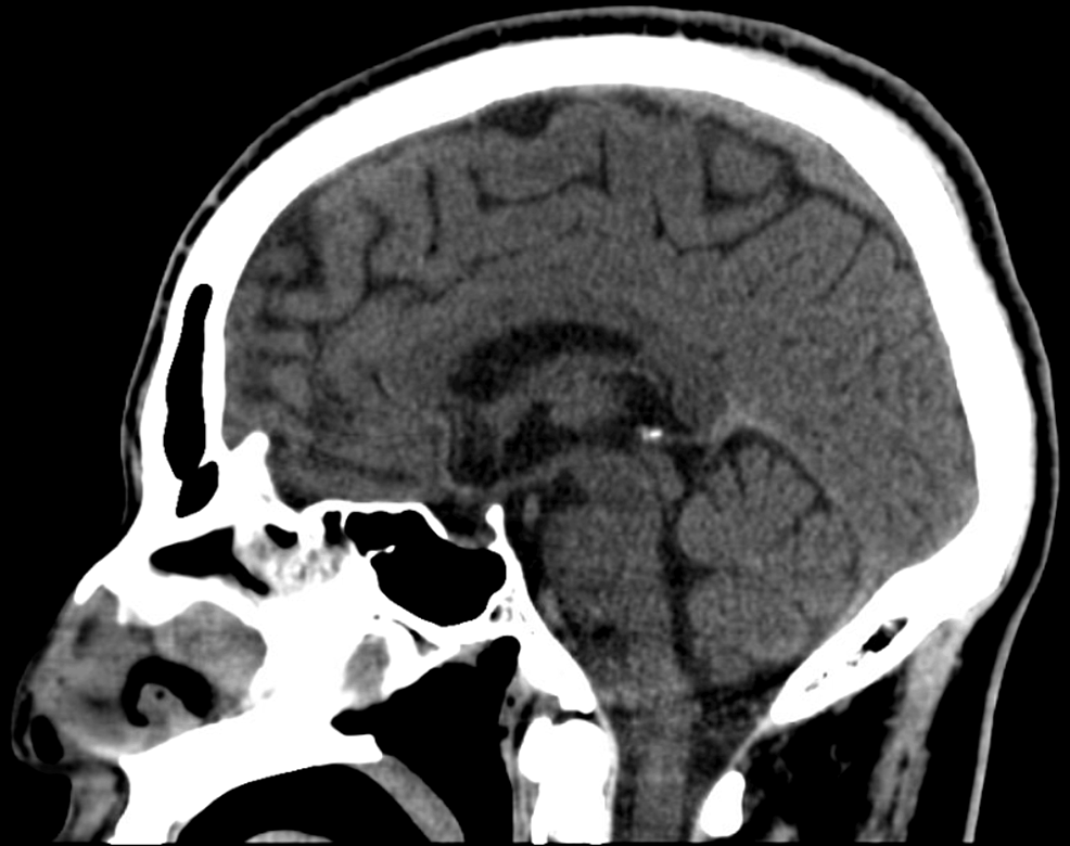 A Case Of Severe Thrombocytopenia Aseptic Meningitis And Hepatitis a-case-of-severe-thrombocytopenia-aseptic-meningitis-and-hepatitis
