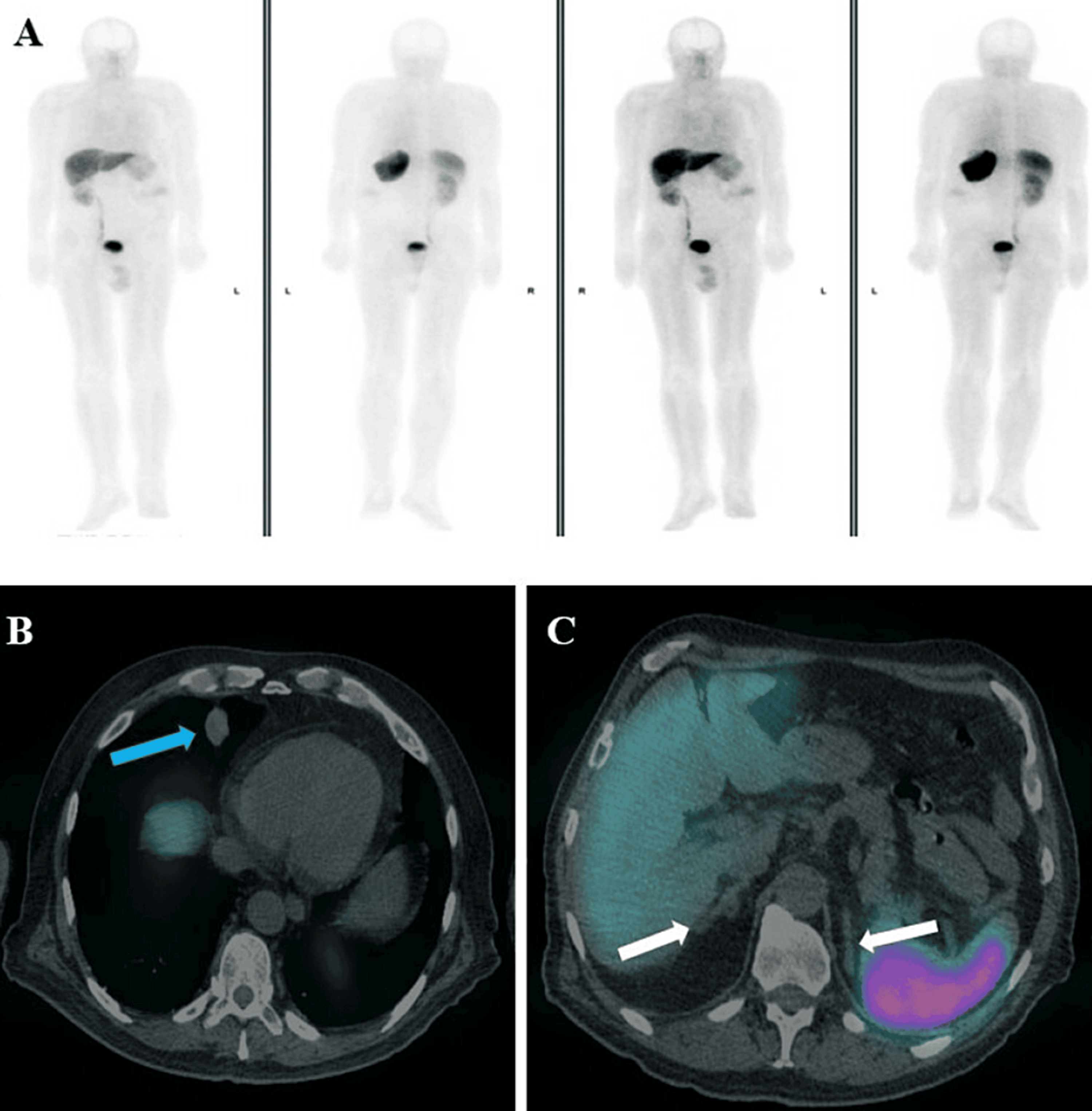 Unusual Presentation Of Case Of A Lung Carcinoid Tumor With Ectopic Adrenocorticotropic 7949