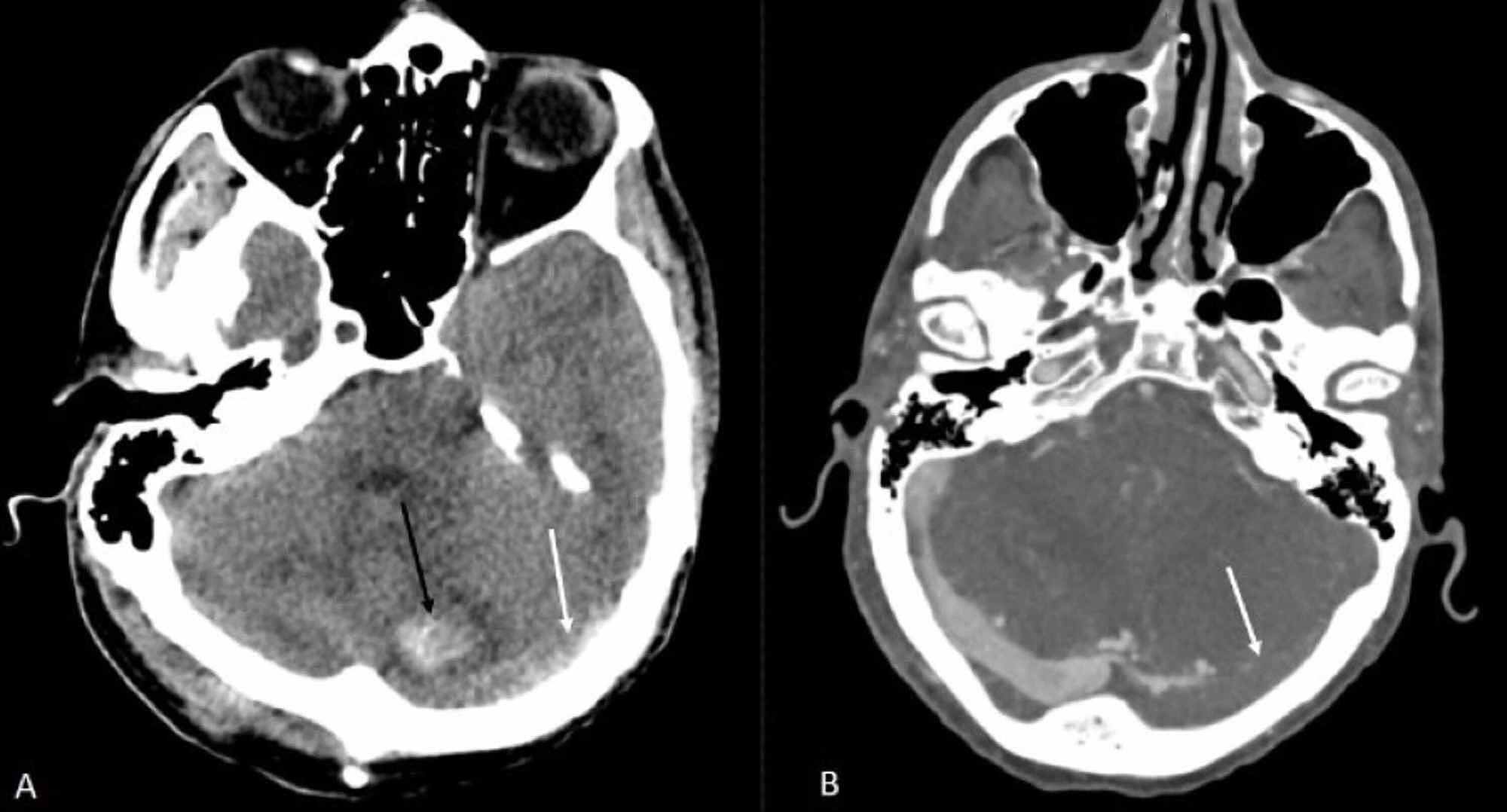 Cureus | A Rare Case of Lemierre's Syndrome Caused by Streptococcus ...