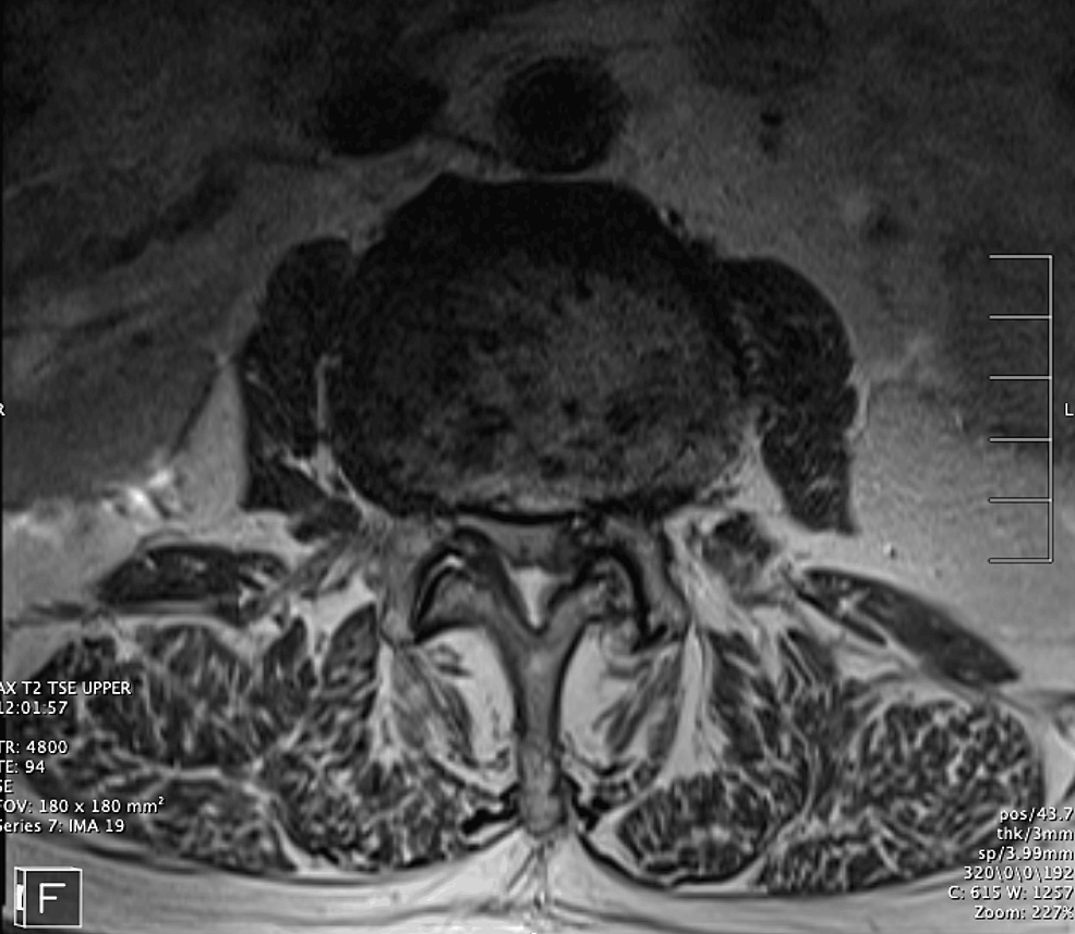 Axial-lumbar-MRI-T2
