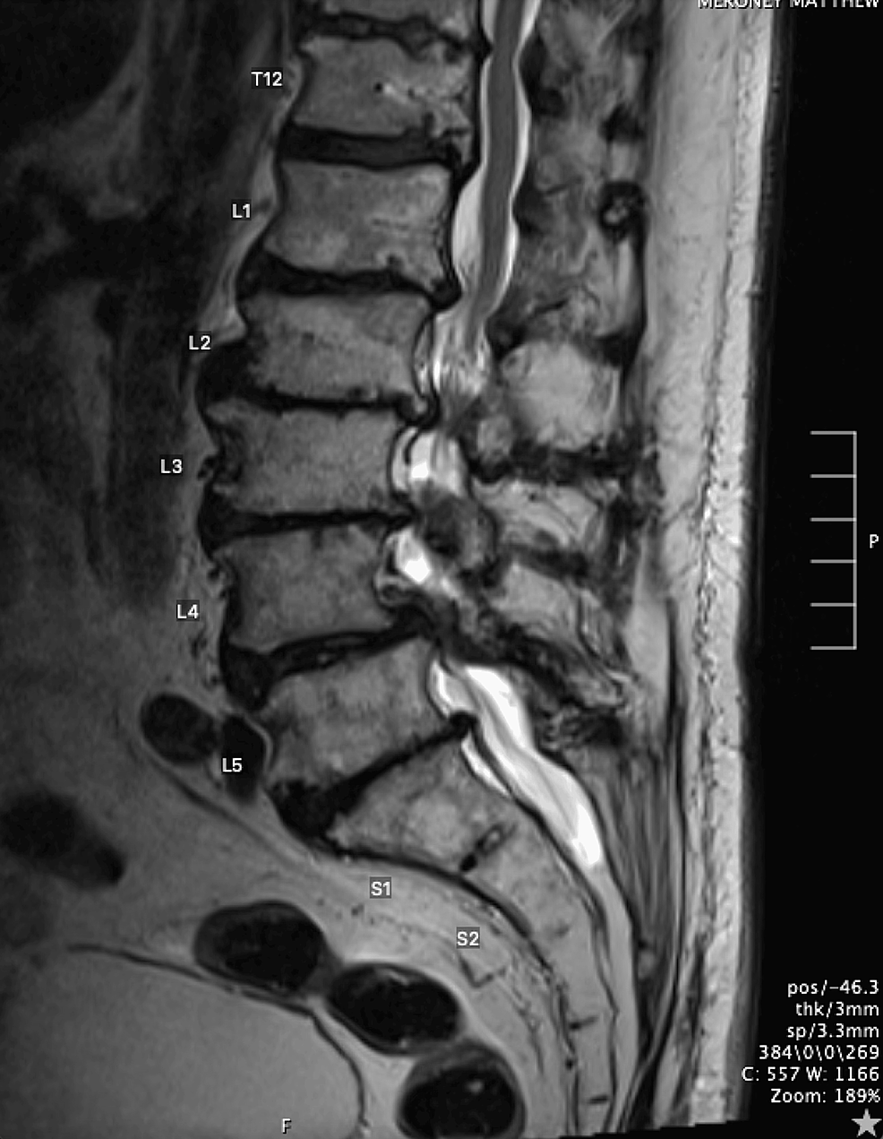 Sagittal-lumbar-MRI-T2