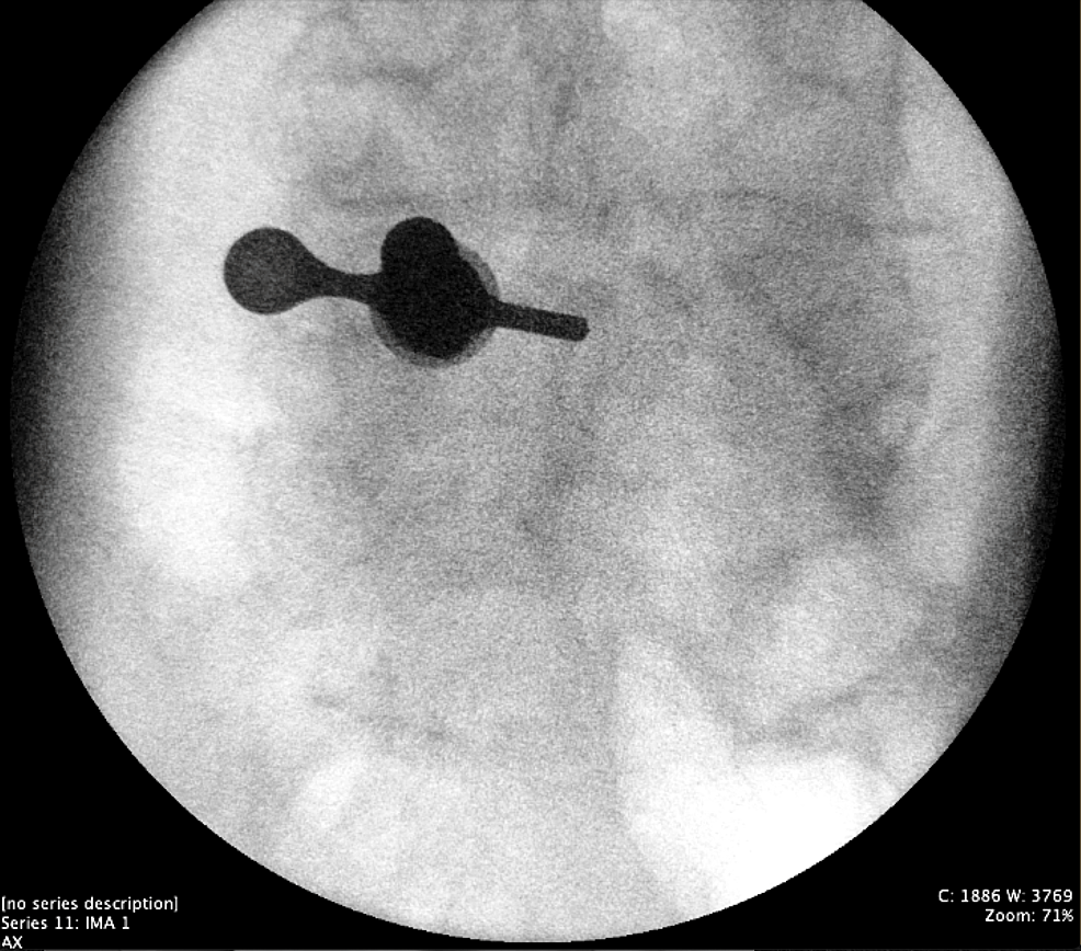 Anterior/posterior-intraoperative-fluoroscopy-of-the-L4/L5-interlaminar-window