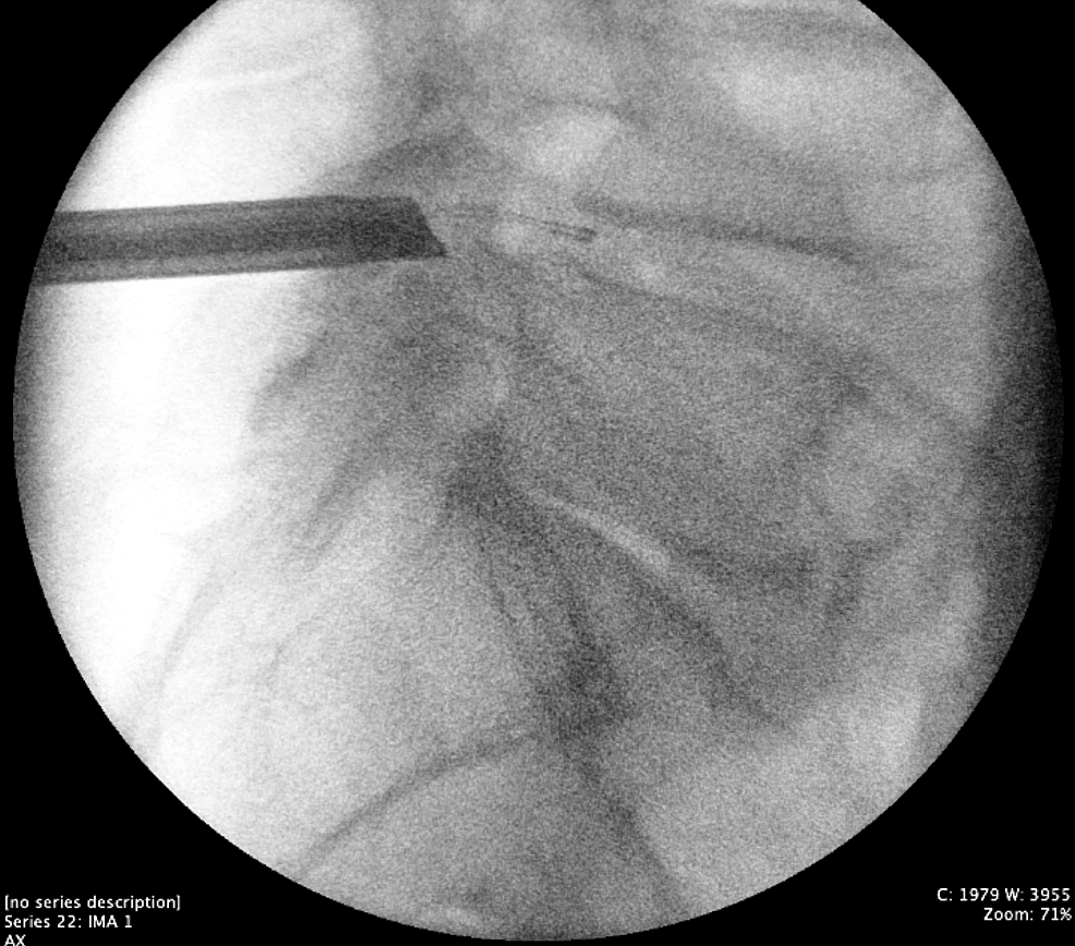 Lateral-intraoperative-fluoroscopy-of-the-L4/5-interlaminar-window