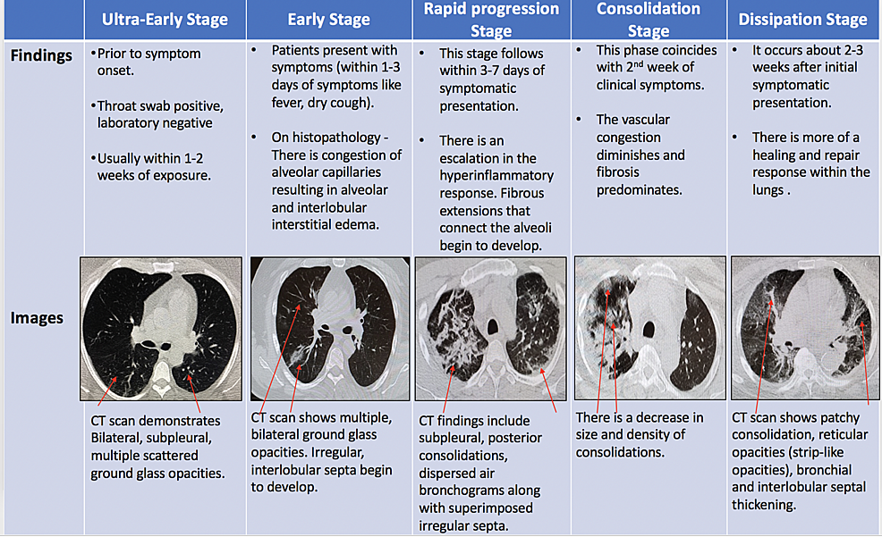 CT-scan-stages-in-patients-with-COVID-19