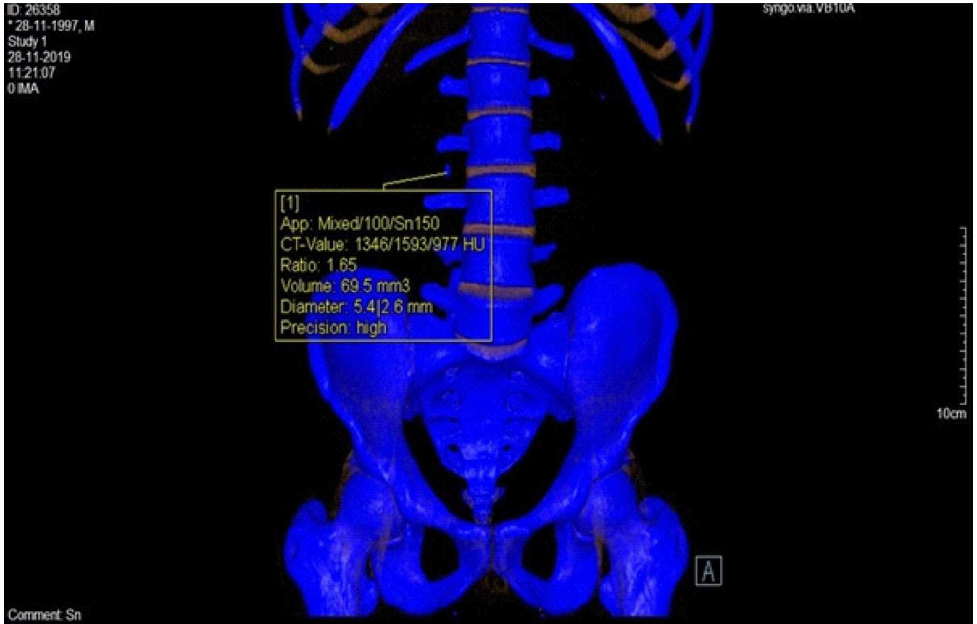 Cureus Role of DualEnergy Computed Tomography in Characterization of