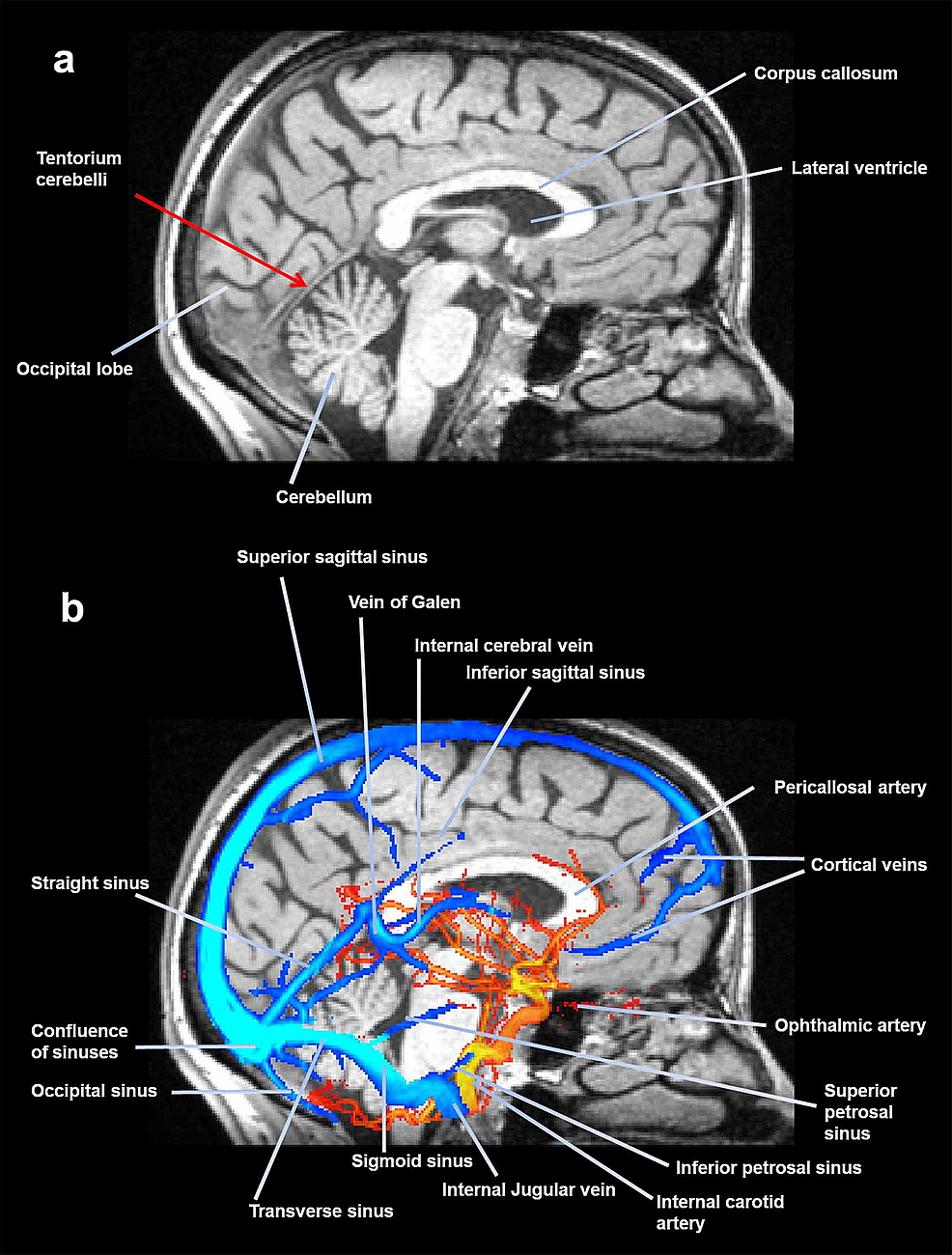 A-midsagittal-slice-of-magnetic-resonance,-where-the-tentorium-is-visible.-