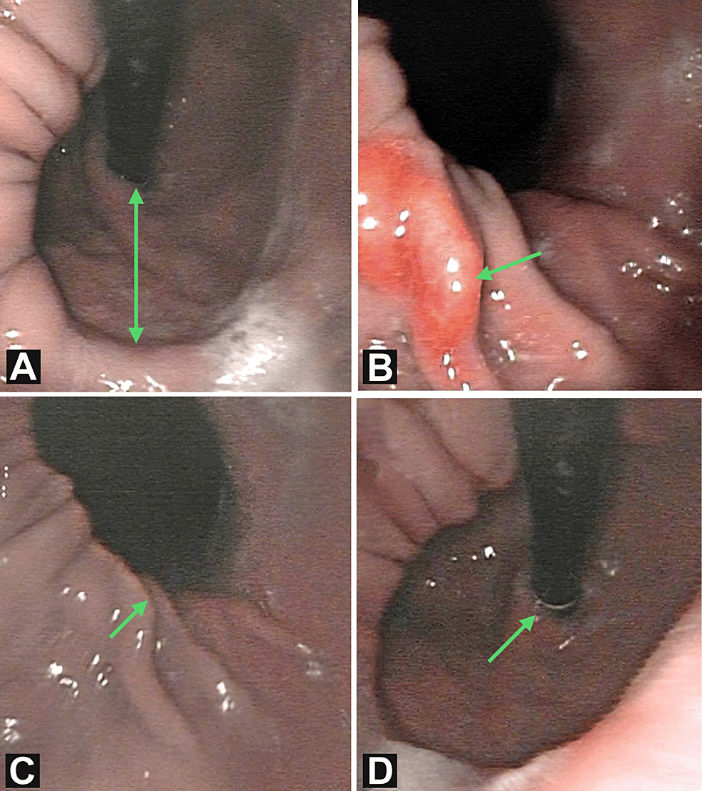 smoking cigarettes before endoscopy reddit Pictures Better Than Words For Scaring Smokers off Hiatal Hernia With Ulcer at