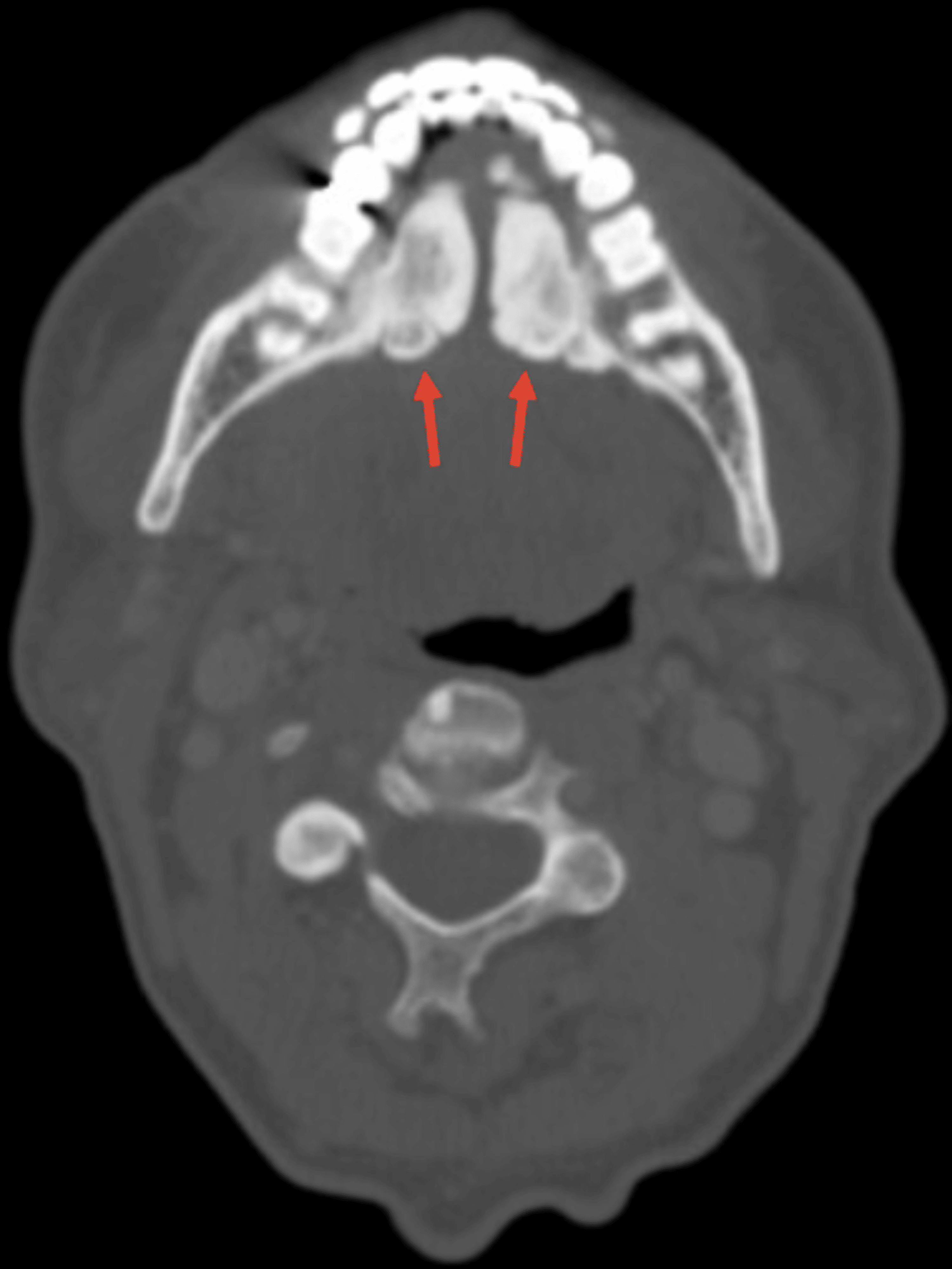 Cureus Sialadenitis Secondary to Bilateral Hypertrophic Torus