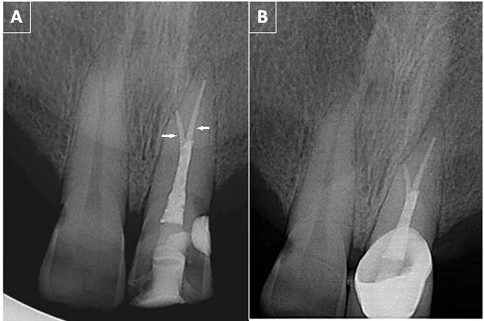 Cureus Endodontic Management of Maxillary Central Incisor with Rare