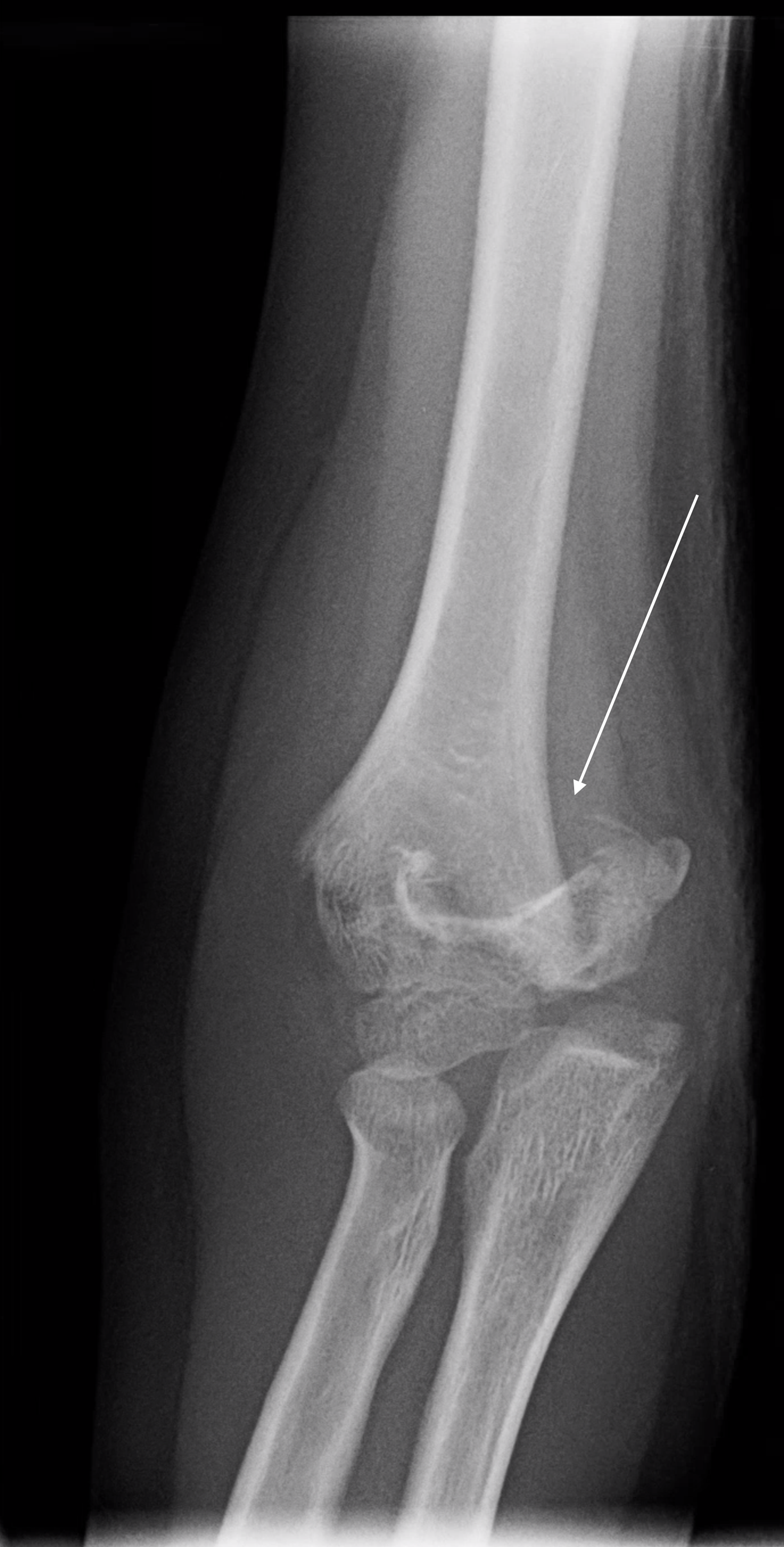 supracondylar fracture of humerus in adults