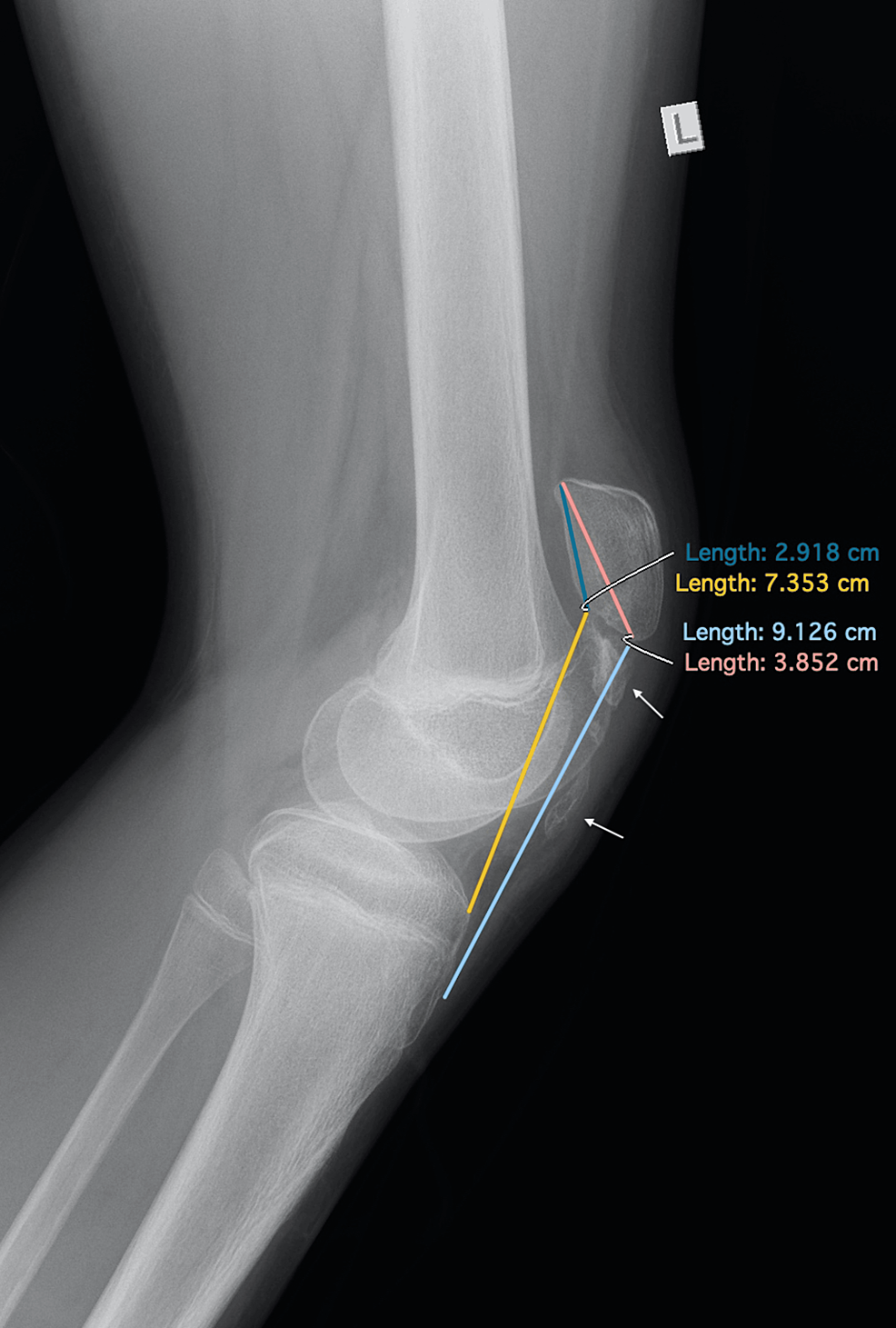 Reconstruction Of A Neglected Patellar Tendon Rupture In An Adolescent ...