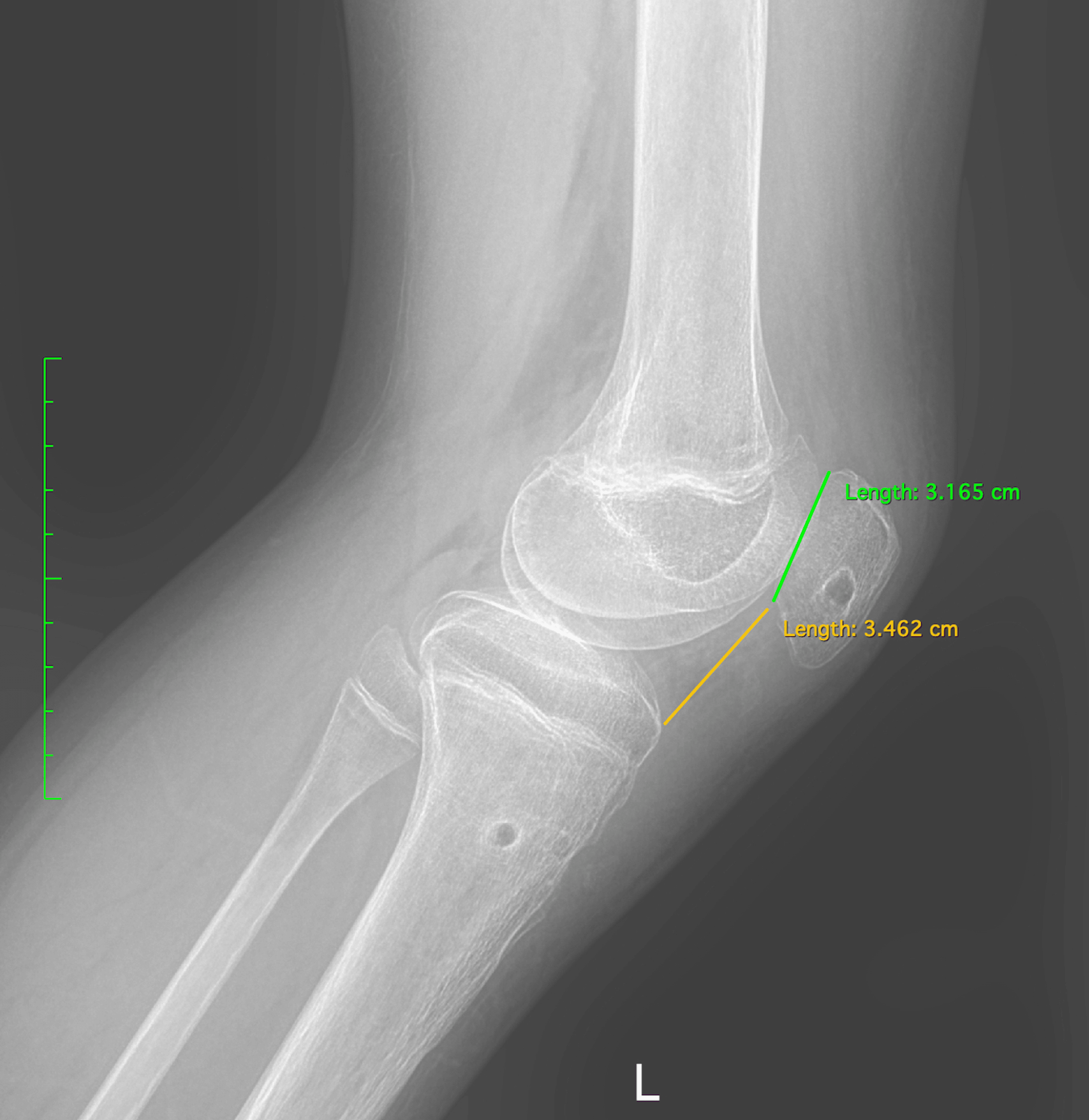 Reconstruction Of A Neglected Patellar Tendon Rupture In An Adolescent ...