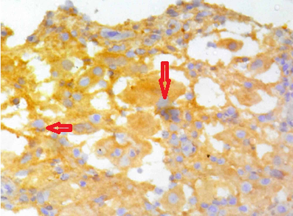 Cureus | Primary Rosai-Dorfman Disease of the Proximal Radius ...