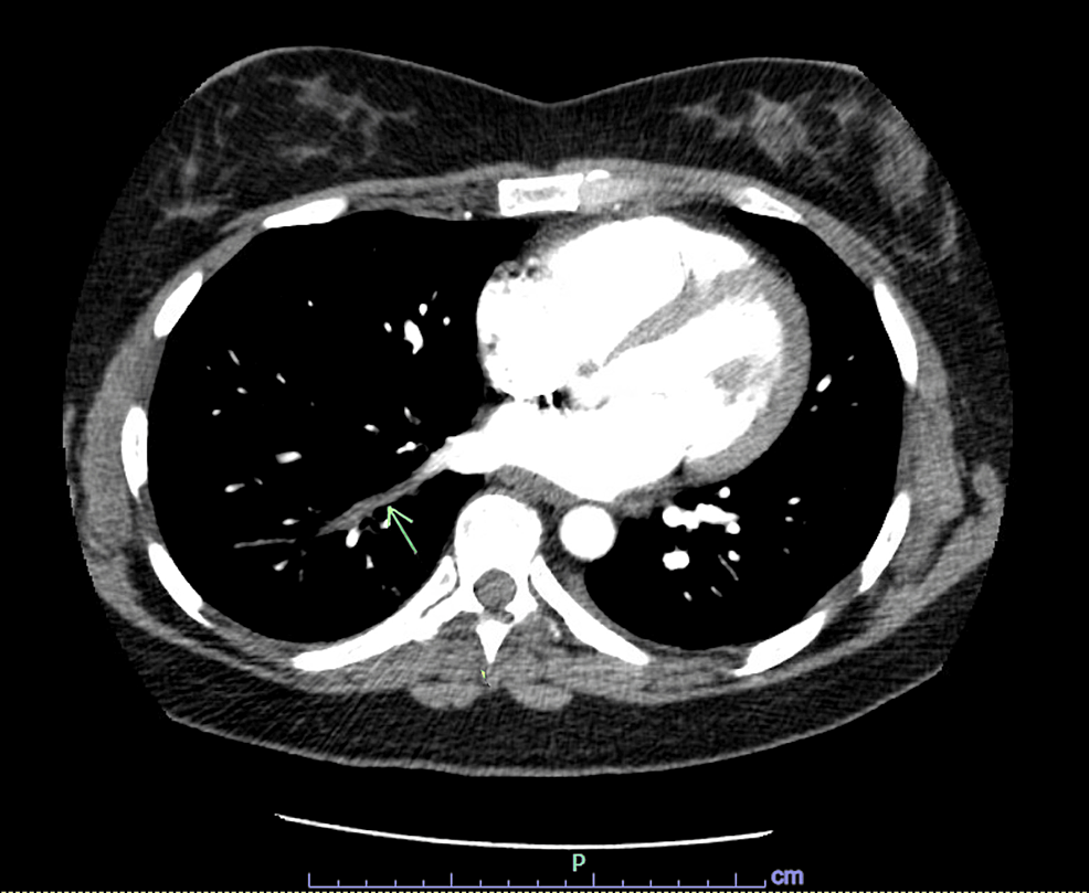 Filling-defect-involving-the-right-lower-lobe-pulmonary-vein.-