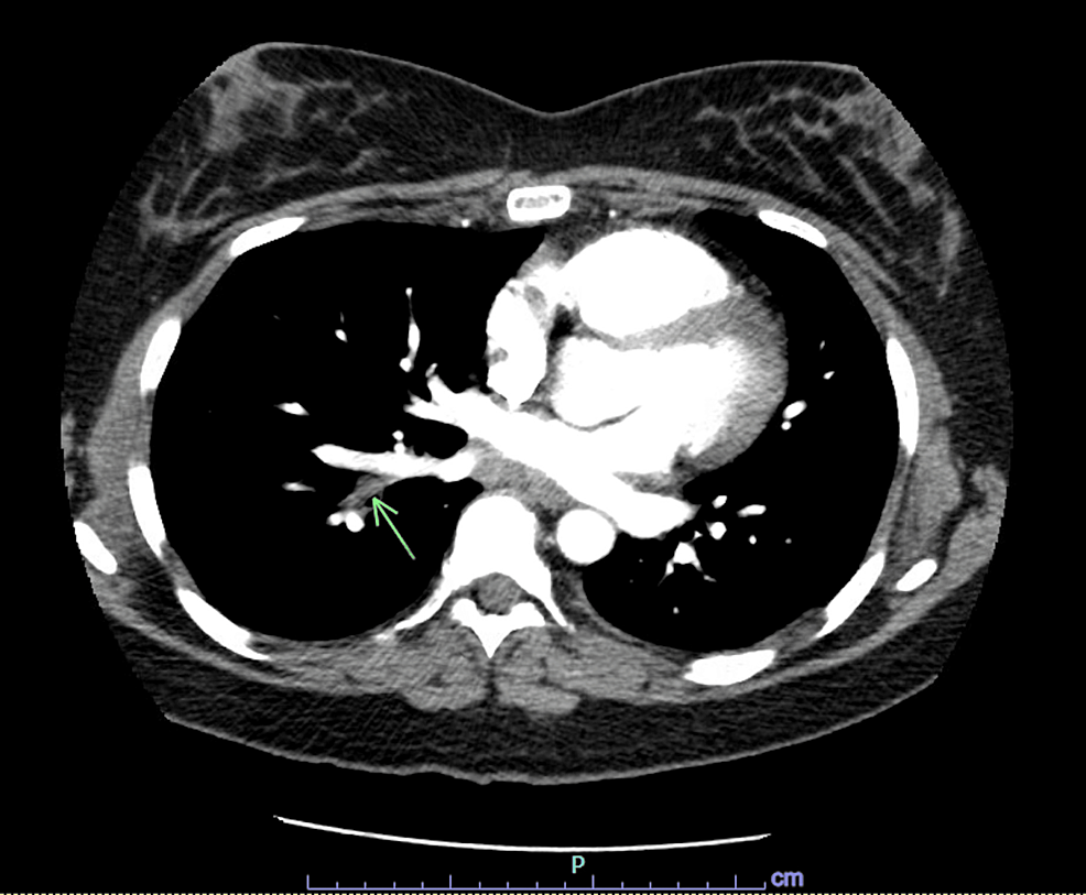 Filling-defect-involving-the-right-lower-lobe-pulmonary-vein.-